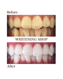 ホワイトニングのbefore afterの写真1