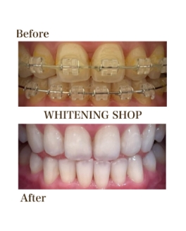 ホワイトニングのbefore afterの写真3